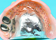 レジリエンツ　残存歯臼歯２歯のケース